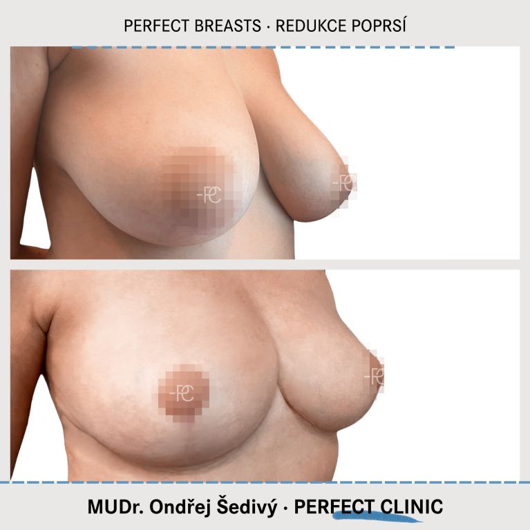 Zmenšení prsou