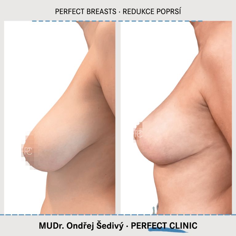 Zmenšení prsou
