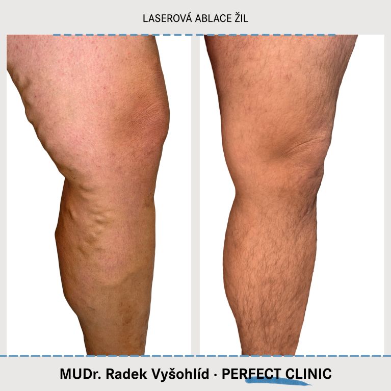 EVLA – Endovenózní laserová ablace