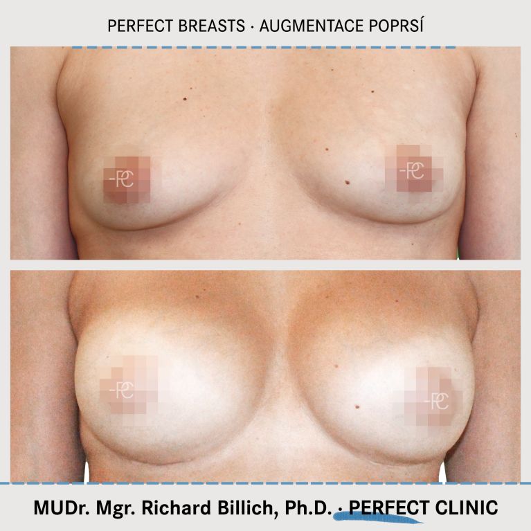 Augmentace poprsí