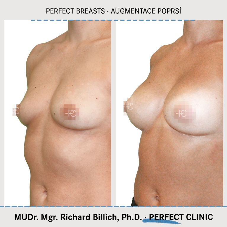Augmentace poprsí