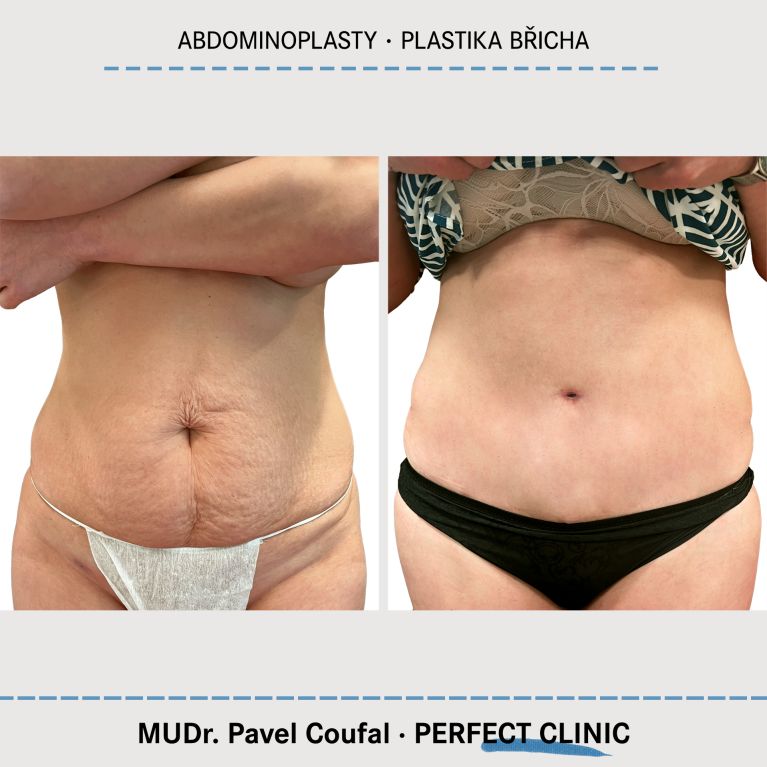 Abdominoplastika