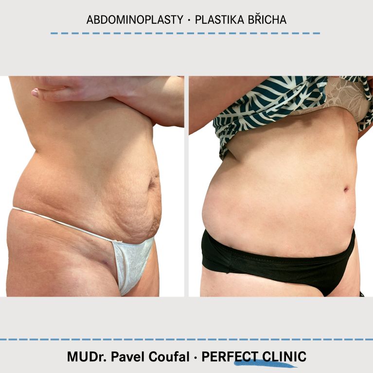 Abdominoplastika