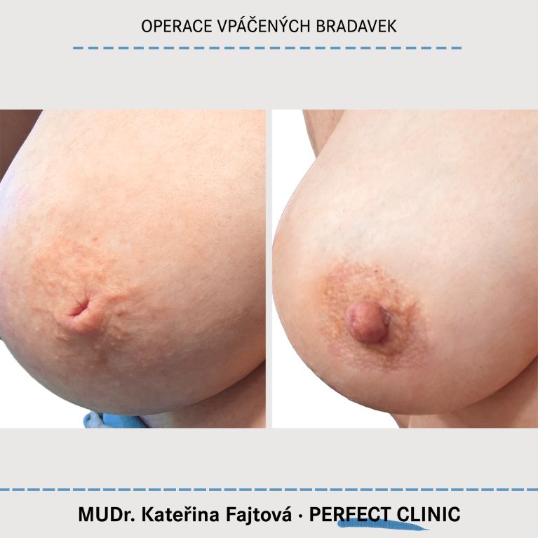 Operace vpáčených bradavek