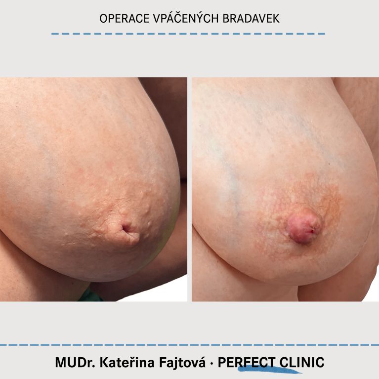 Operace vpáčených bradavek