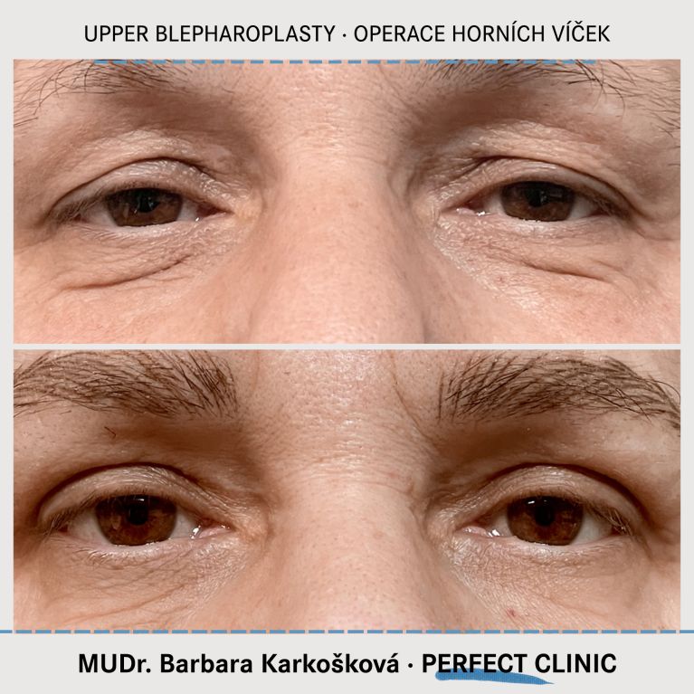 Operace horních víček