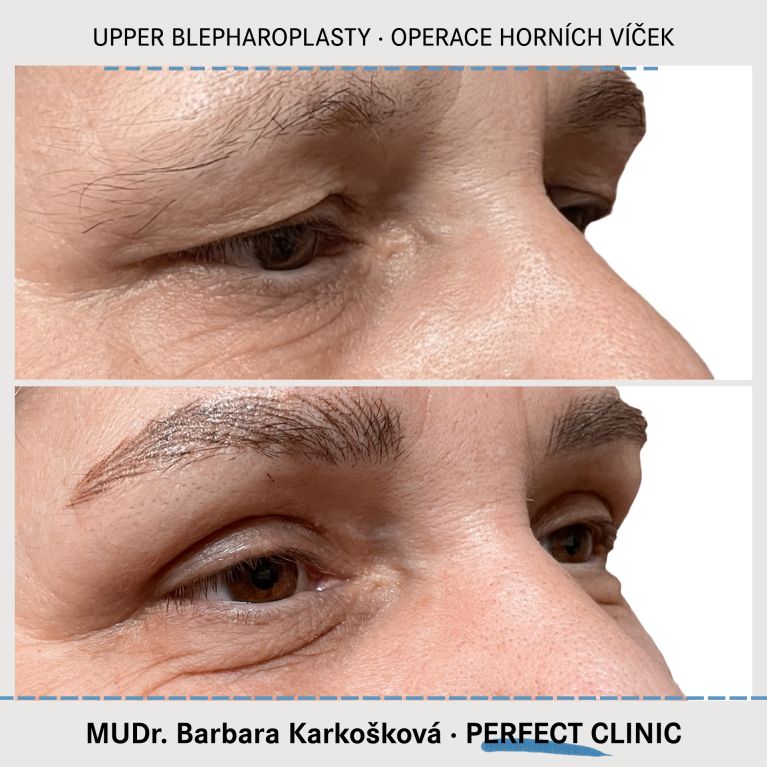 Operace horních víček