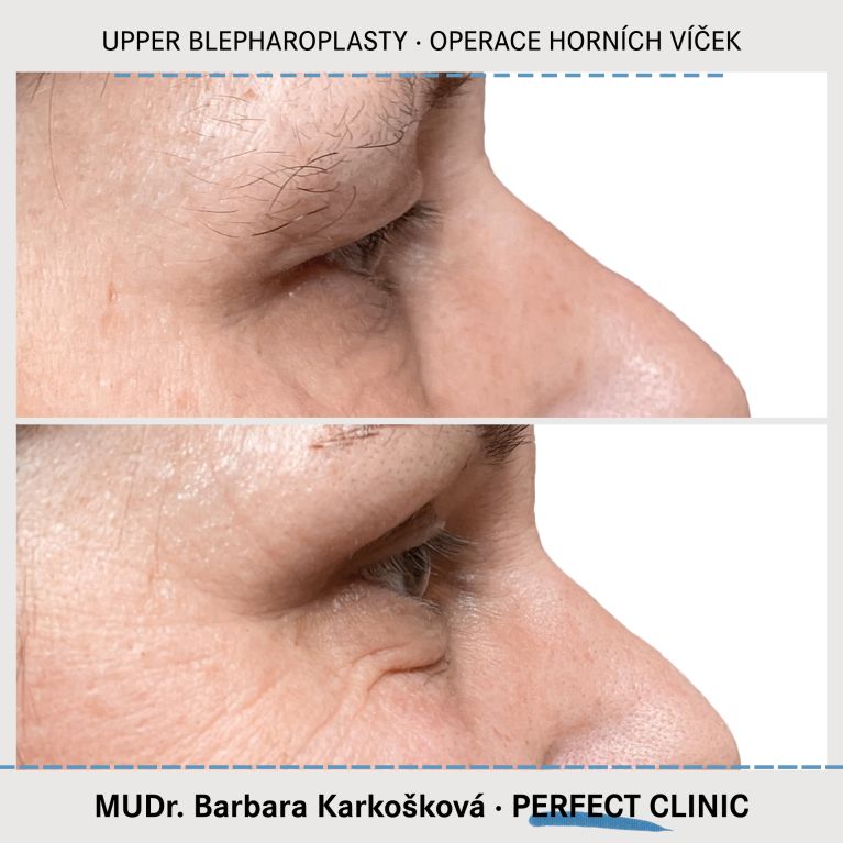 Operace horních víček
