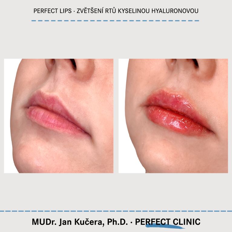 Zvětšení rtů kyselinou hyaluronovou