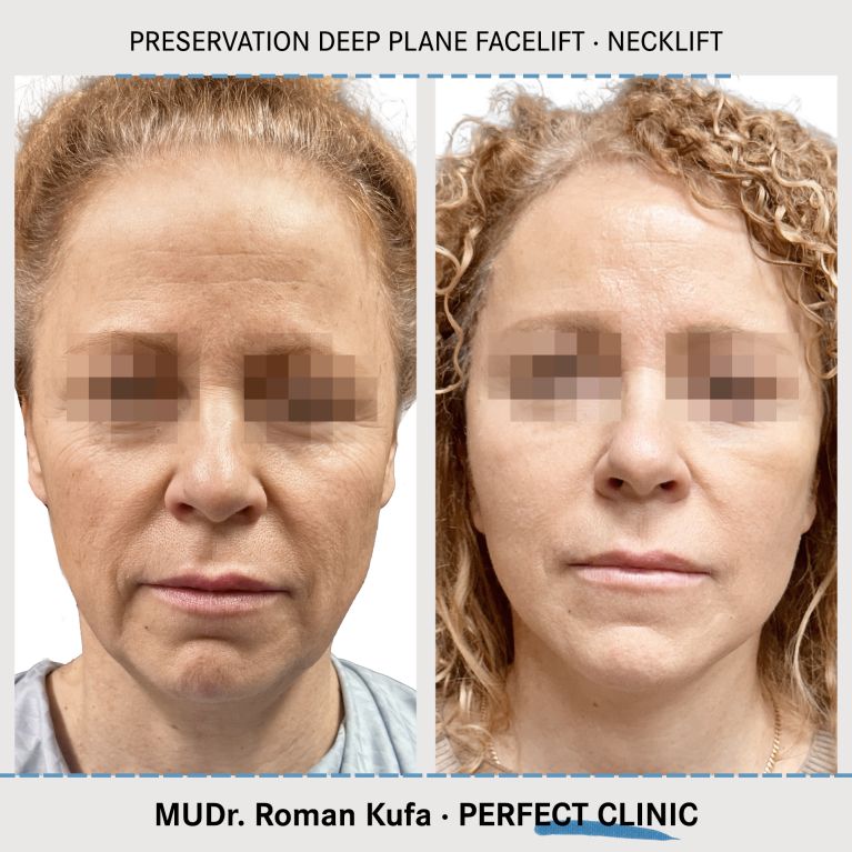 Facelift • Necklift