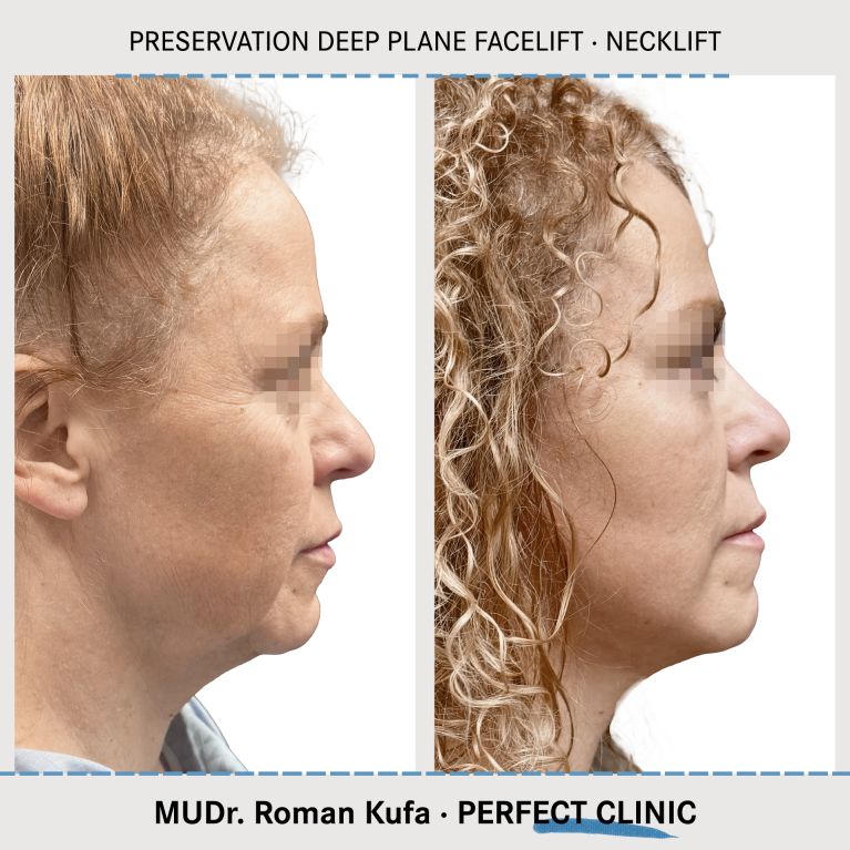 Facelift • Necklift