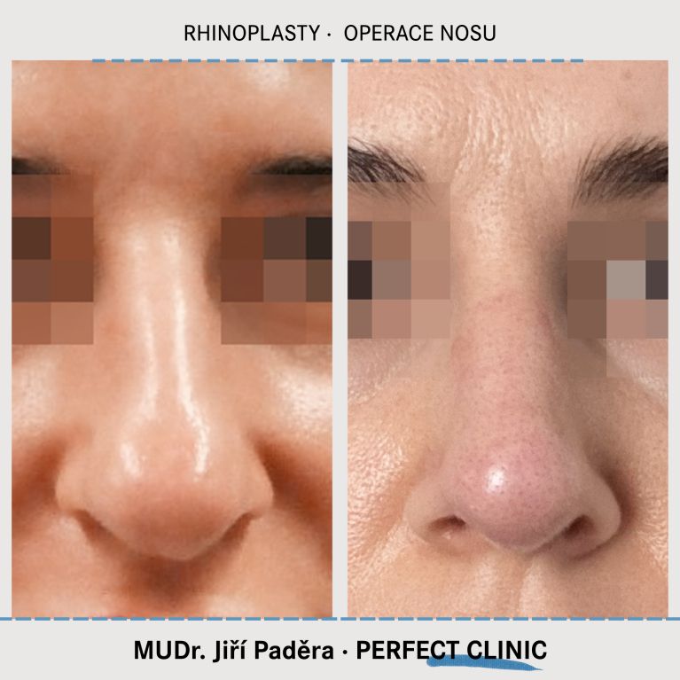 Rhinoplastika