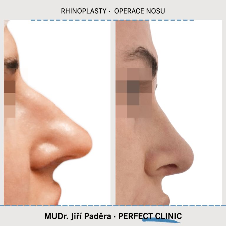 Rhinoplastika