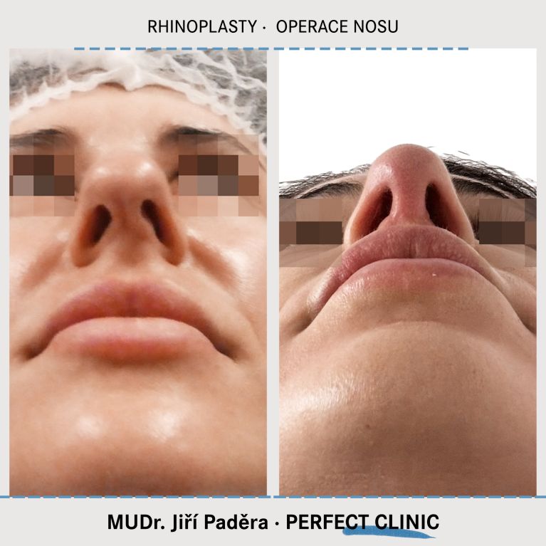Rhinoplastika