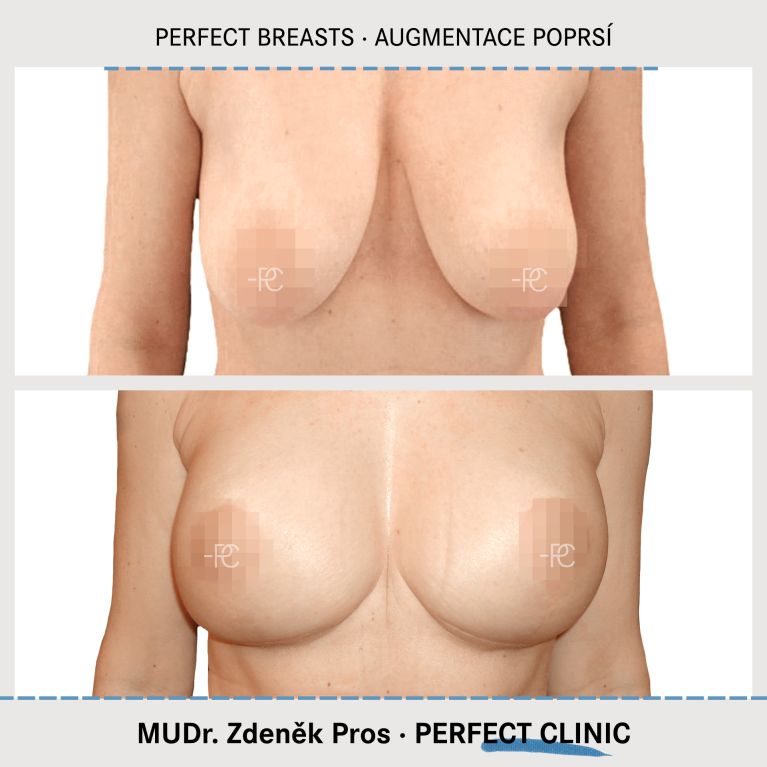 Augmentace poprsí