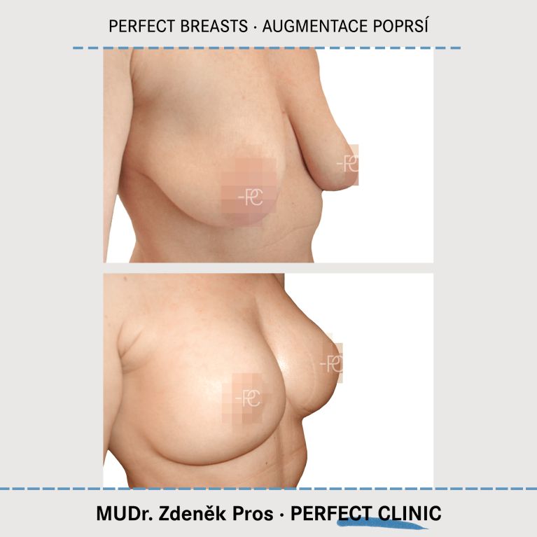 Augmentace poprsí