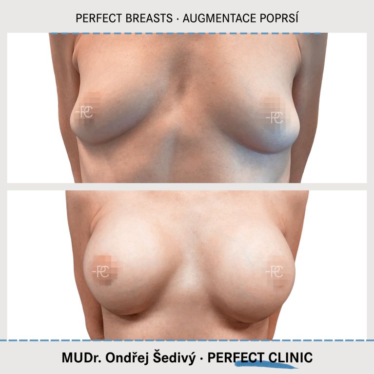 Augmentace poprsí