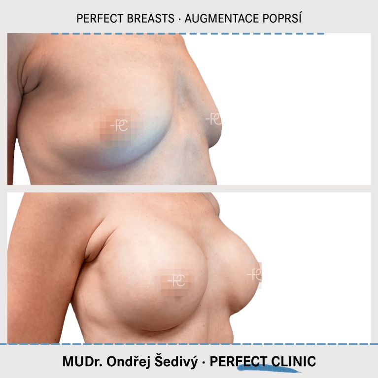 Augmentace poprsí