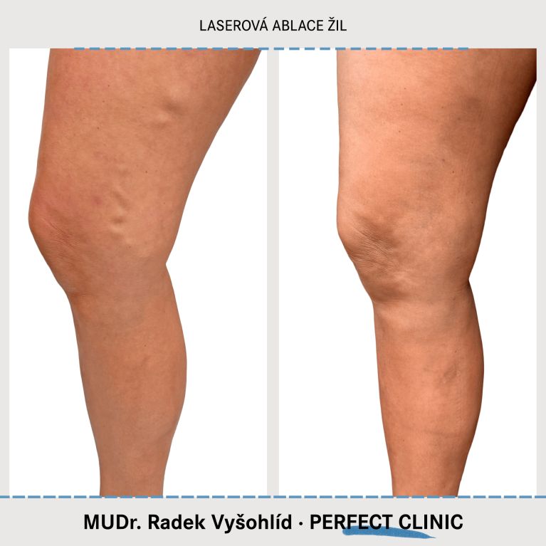 EVLA – Endovenózní laserová ablace