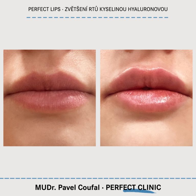 Zvětšení rtů kyselinou hyaluronovou
