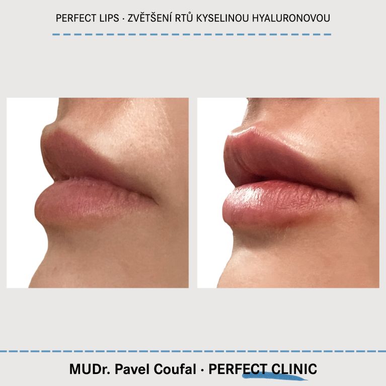 Zvětšení rtů kyselinou hyaluronovou