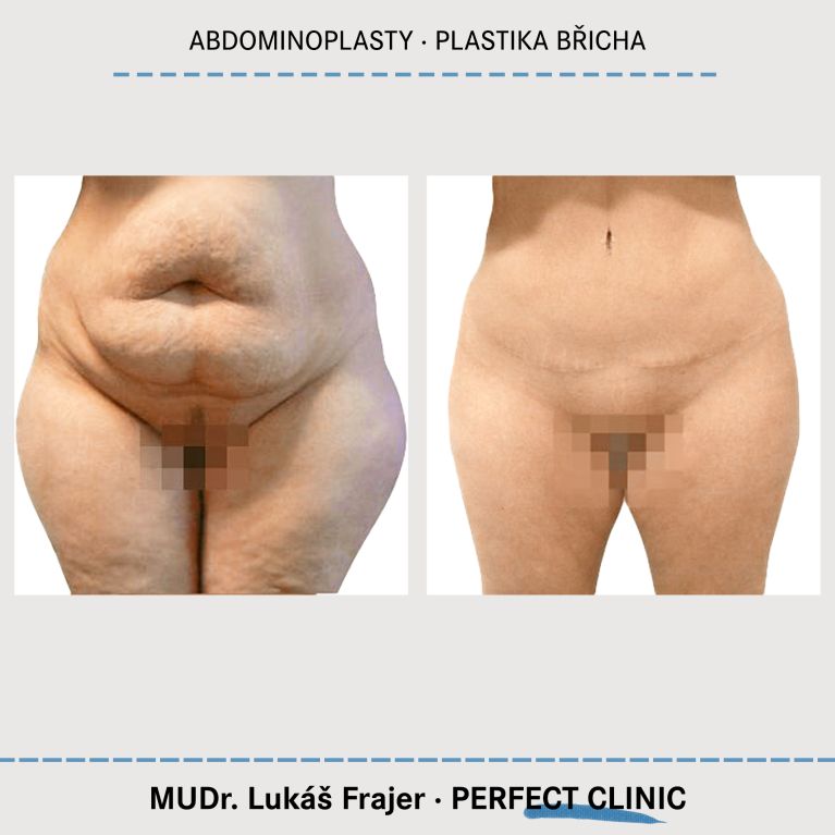 Abdominoplastika