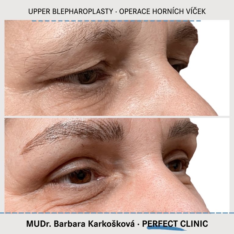 Operace horních víček