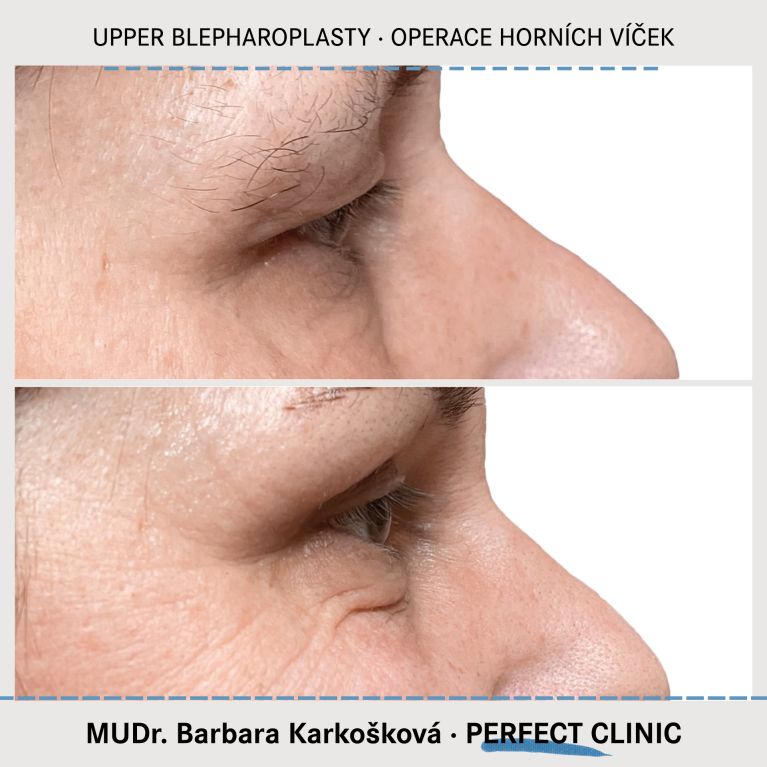 Operace horních víček