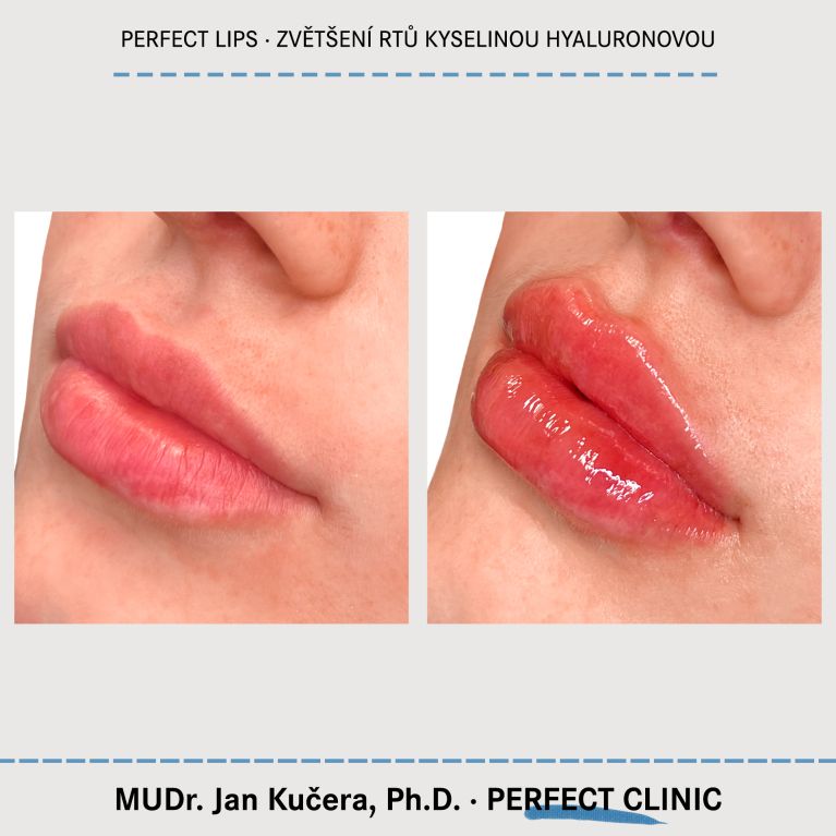 Zvětšení rtů kyselinou hyaluronovou
