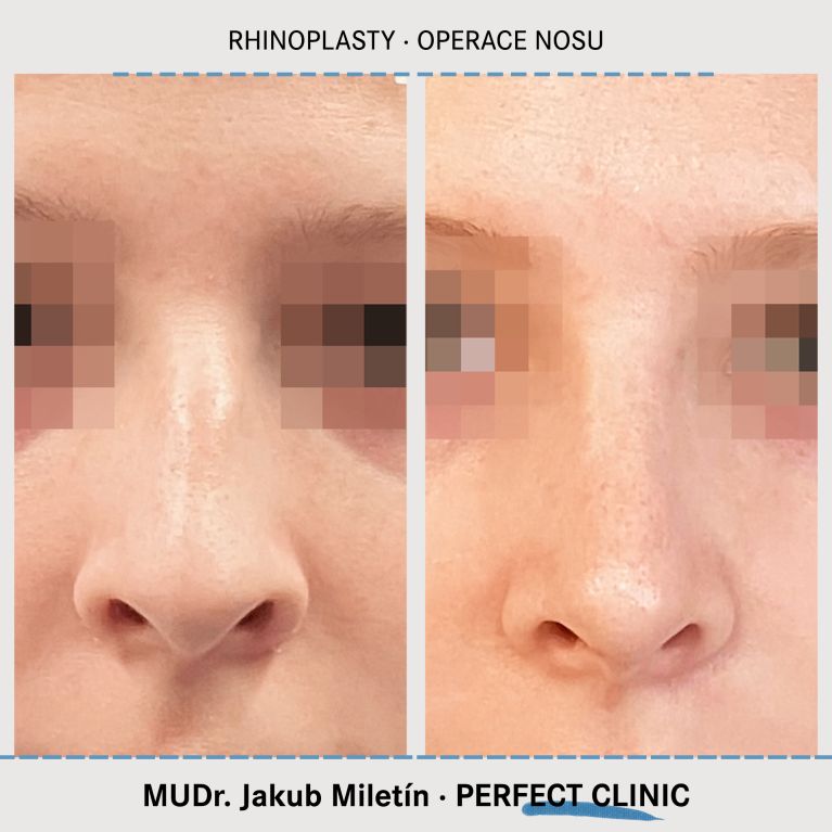 Rhinoplastika