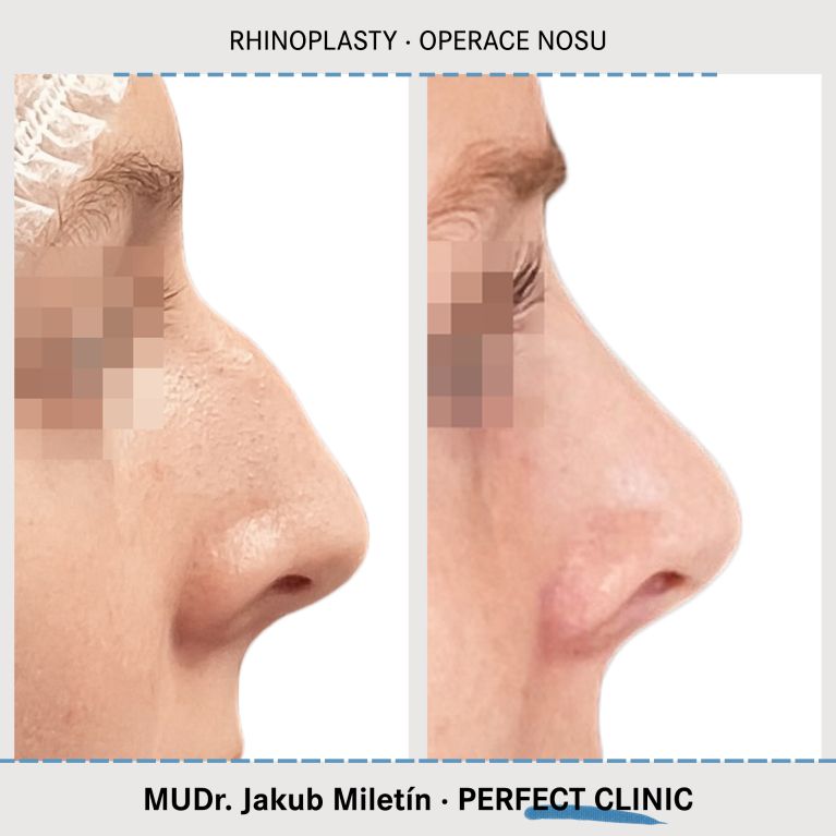 Rhinoplastika