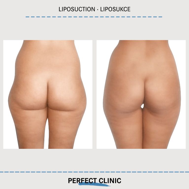 Liposukce
