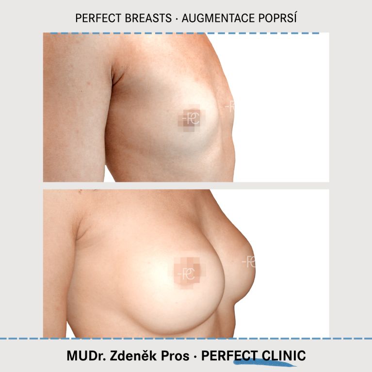 Augmentace poprsí