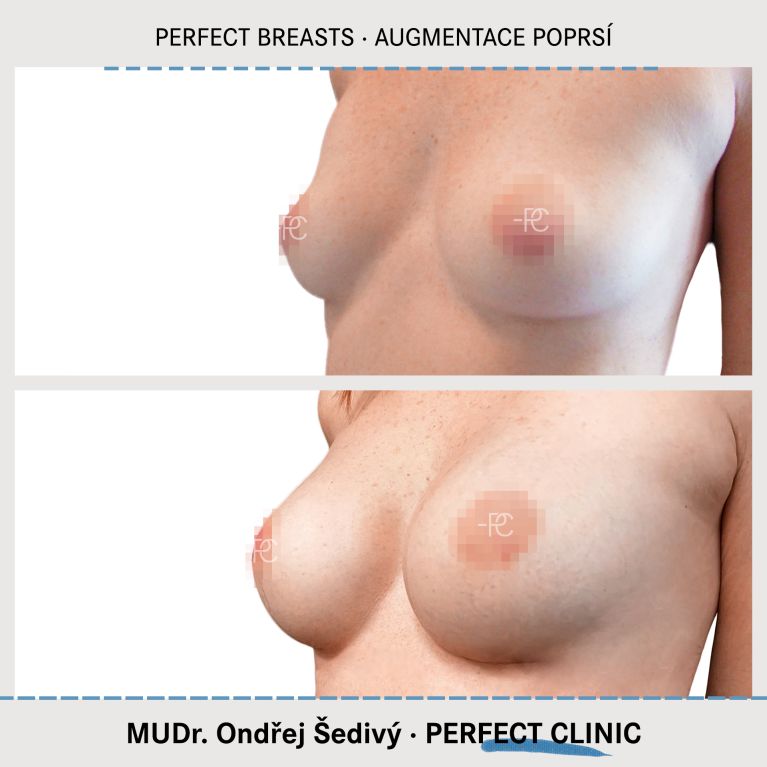 Augmentace poprsí