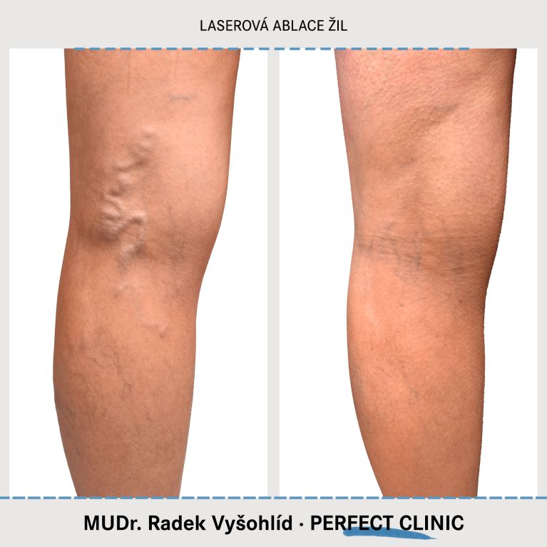 EVLA – Endovenózní laserová ablace