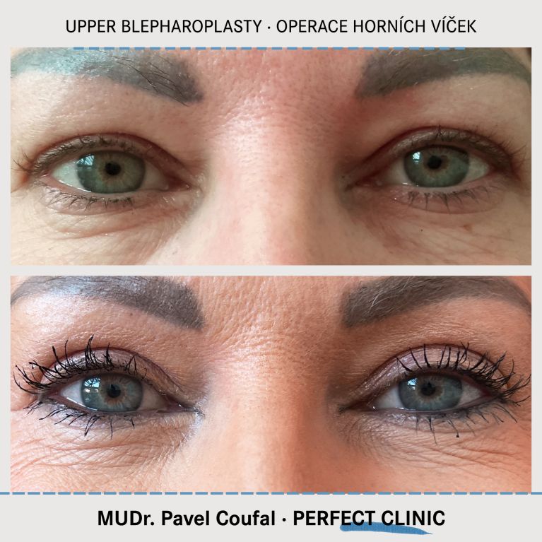 Operace horních víček
