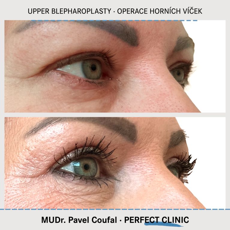 Operace horních víček
