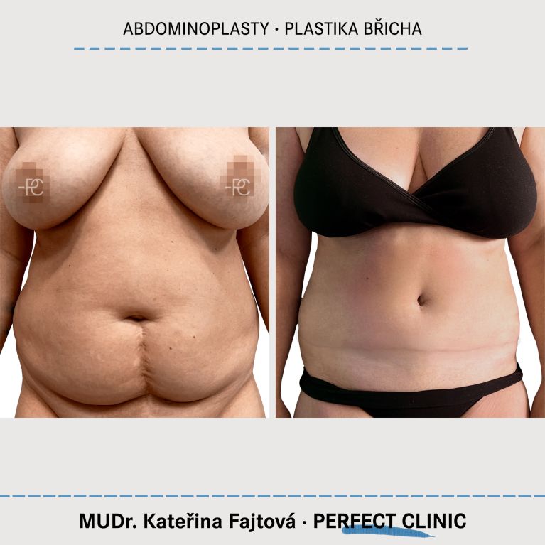 Abdominoplastika