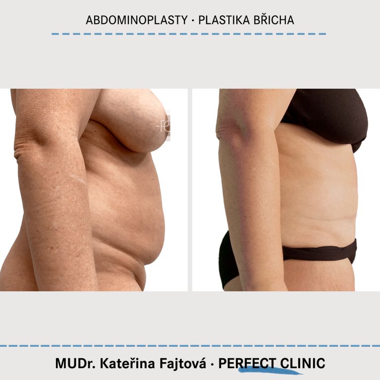 Abdominoplastika