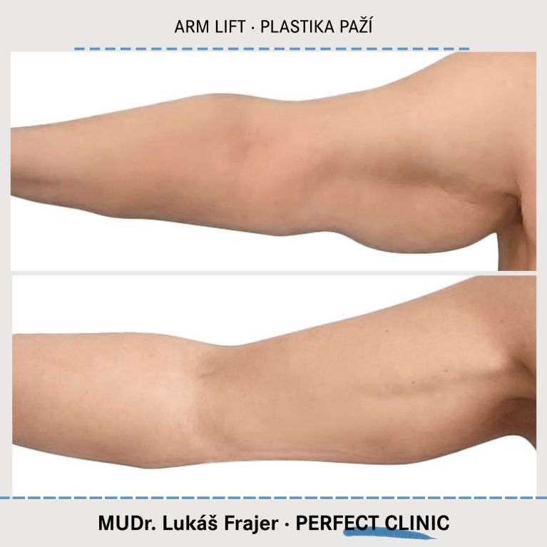 Plastická operace paží