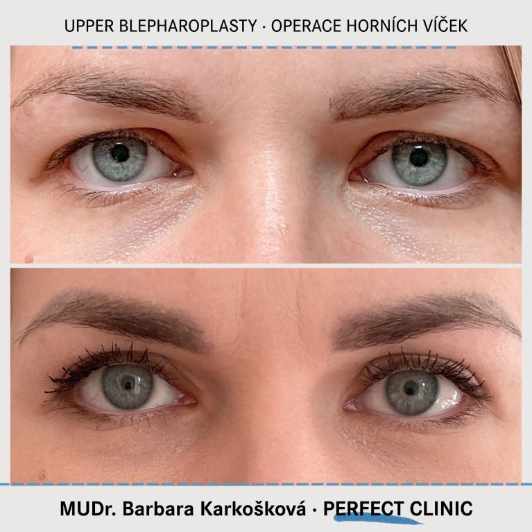 Operace horních víček