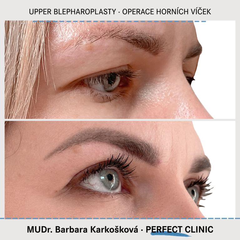 Operace horních víček