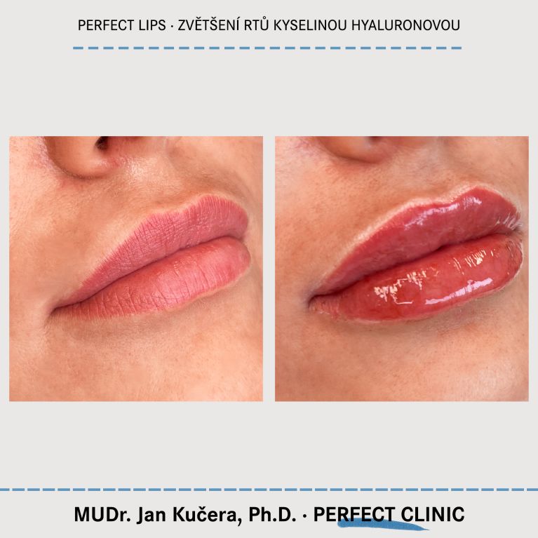 Zvětšení rtů kyselinou hyaluronovou