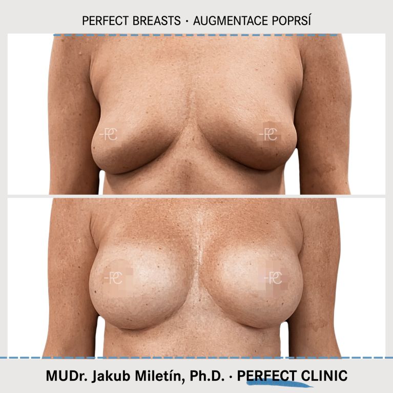 Augmentace poprsí