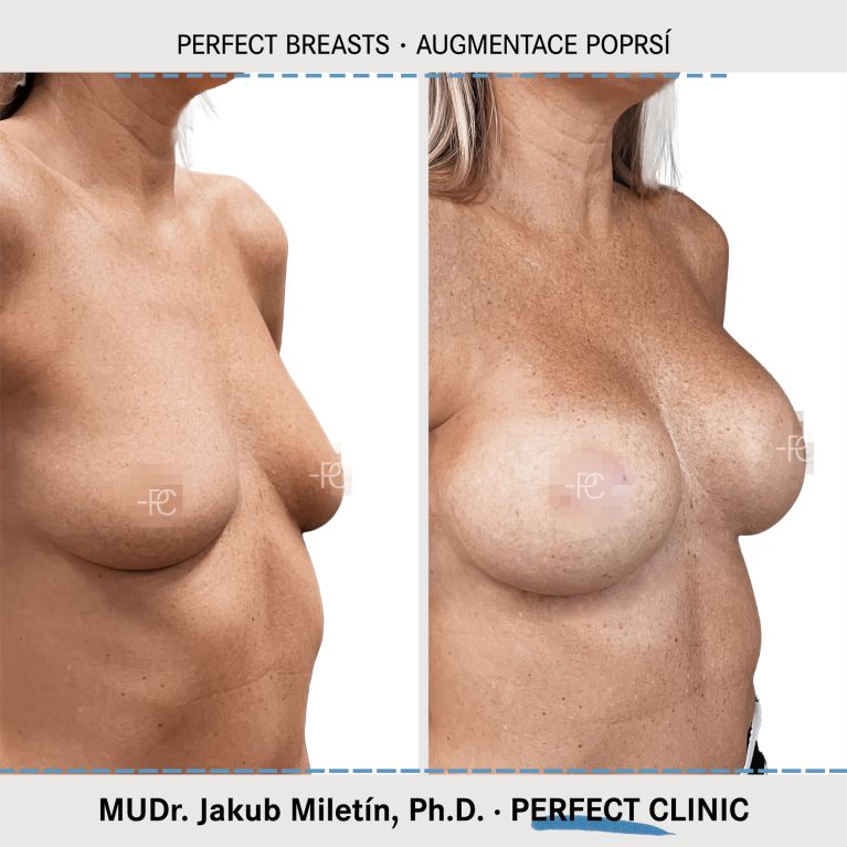 Augmentace poprsí