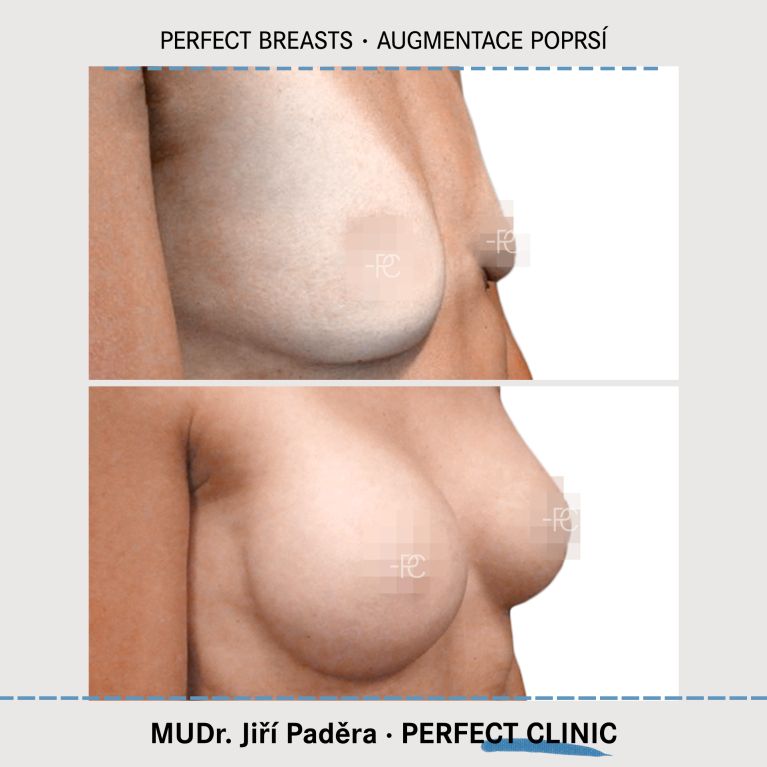 Augmentace poprsí