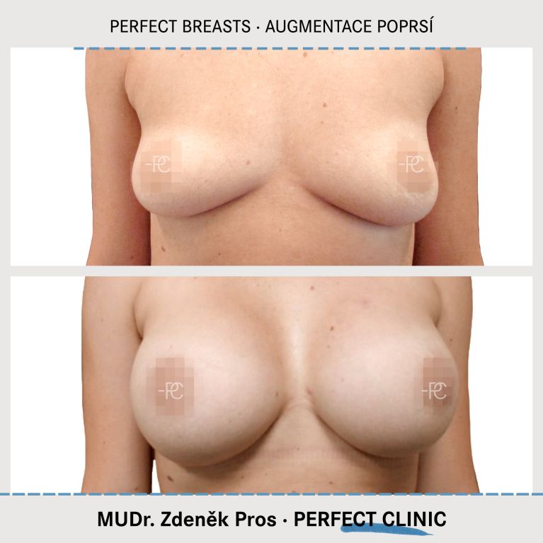 Augmentace poprsí