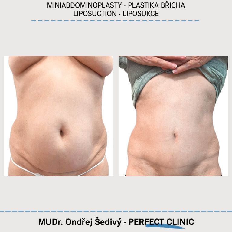 Abdominoplastika & Liposukce