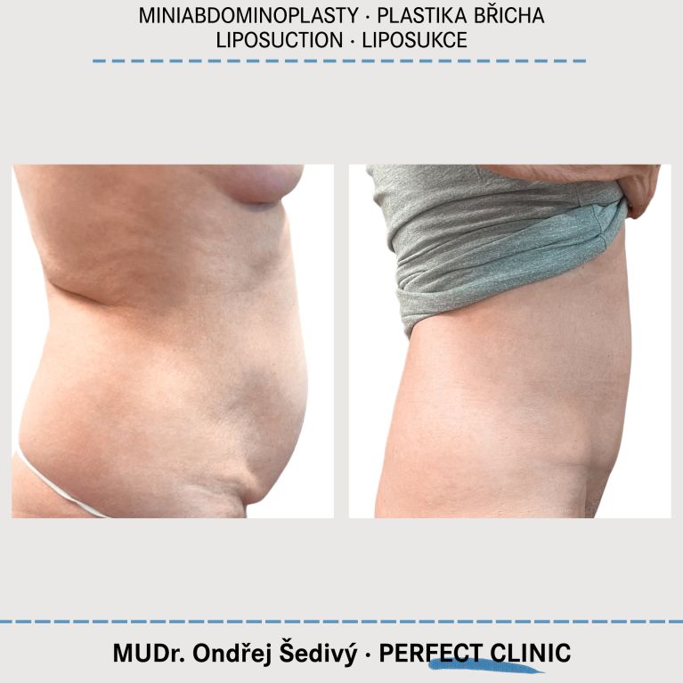 Abdominoplastika & Liposukce