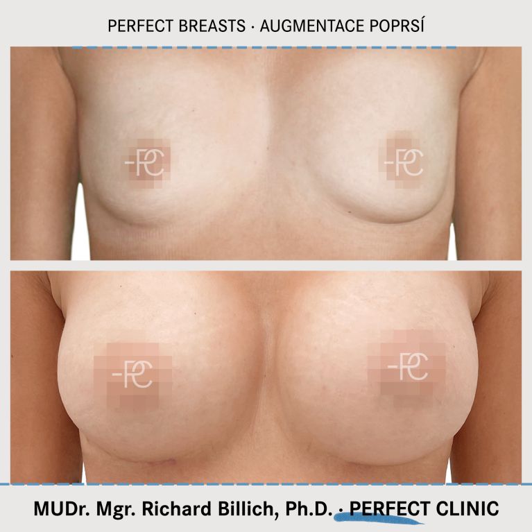 Augmentace poprsí